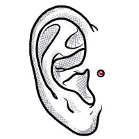 Dermal Anchor Piercing (Implantat) am Ohr
