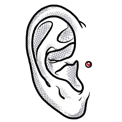 Dermal Anchor (Implantat) Am Ohr