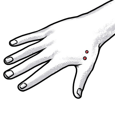 Dermal Anchor (Implantat) An Der Hand